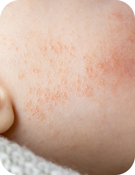 Baby with red skin on his cheeks